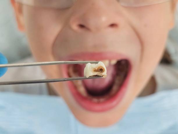 Best Emergency Dental Care for Broken or Chipped Teeth in O, MI